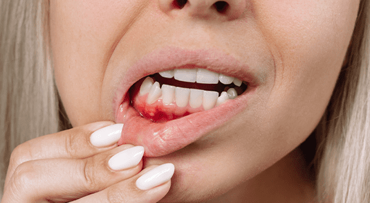 Close-up of inflamed and bleeding gums